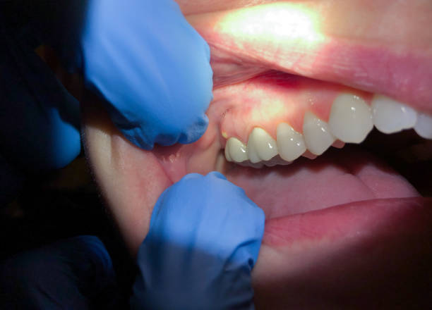 Best Emergency Dental Care for Broken or Chipped Teeth in Ripley, MS